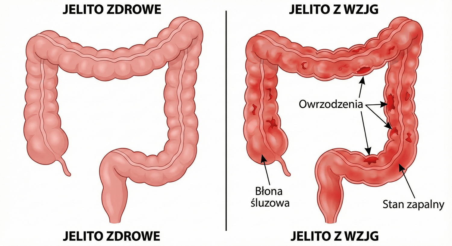 Wrzodziejące zapalenia jelita grubego – wzjg objawy, przyczyny, co to jest?