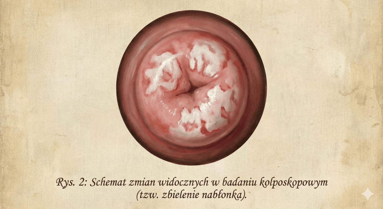 Widok z badania kolposkopowego szyjki macicy, pokazujący charakterystyczne zbielenie nabłonka po próbie z kwasem octowym