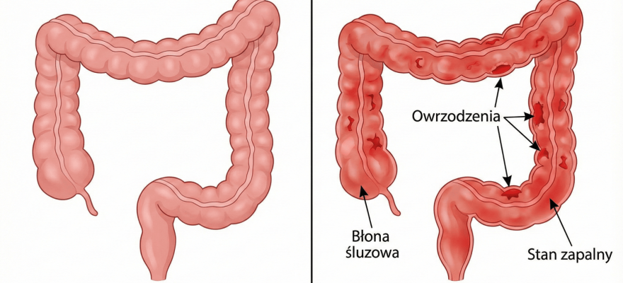 Wrzodziejące zapalenia jelita grubego – wzjg objawy, przyczyny, co to jest?
